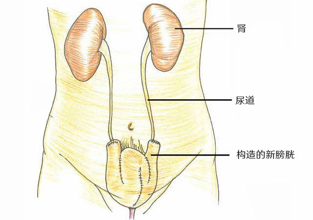 膀胱全切术后构造新的膀胱