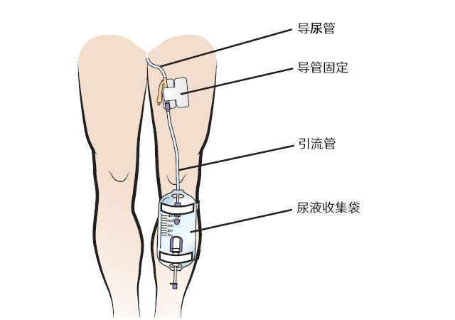 膀胱全切术后腿部挂袋图片
