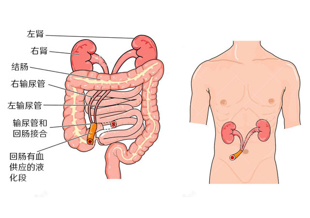 回肠膀胱术-将输尿管连接到皮肤的小肠段