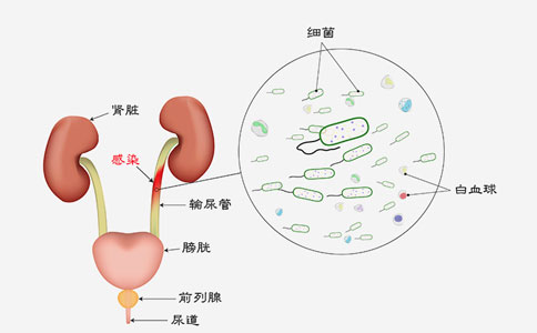 膀胱炎的症状和肾病的区别