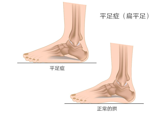 平足症与正常脚对比图