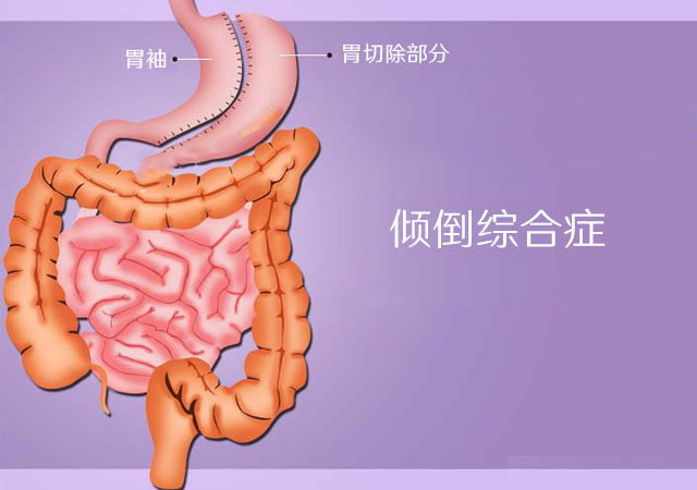 倾倒综合征示意图