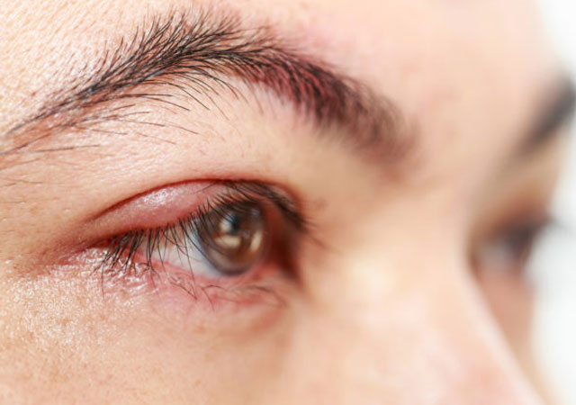 轻度眼睑蜂窝织炎的症状治疗