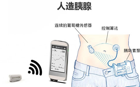 2021糖尿病治愈可能吗有哪些最新治疗方法技术