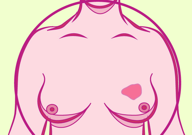 乳腺癌早期信号之一乳房皮肤变化的症状