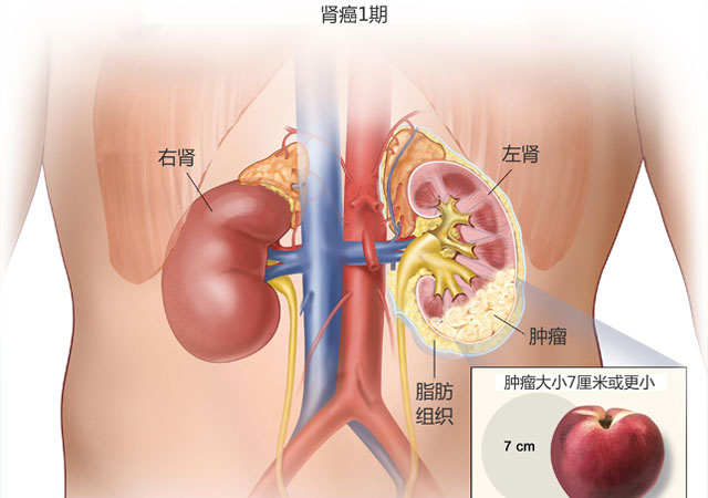 肾癌1期