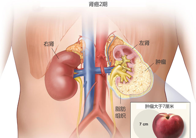 肾癌2期