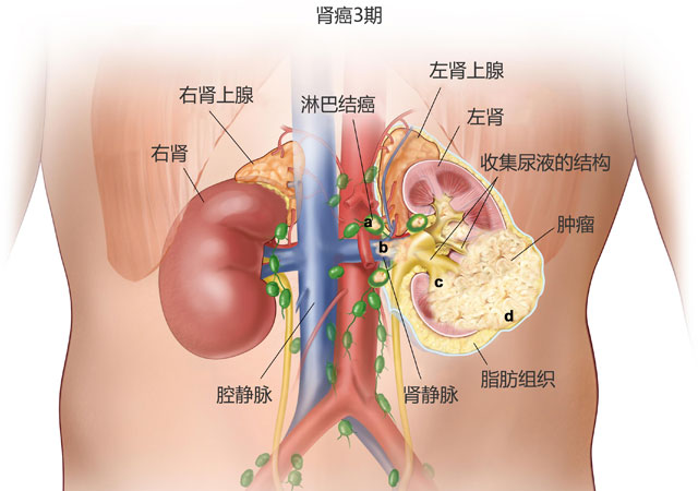 肾癌3期