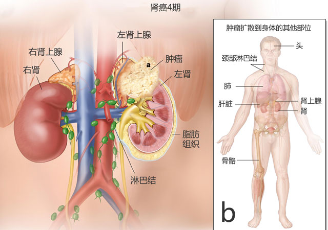 肾癌4期