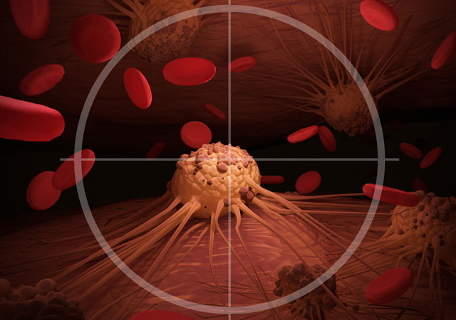 肾癌吃靶向药有针对性的治疗杀死癌细胞