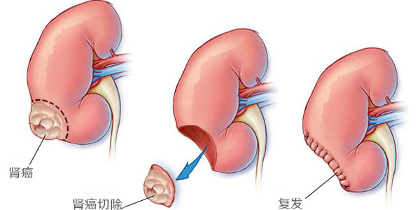 肾癌早期切除术后肾肿瘤复发概率