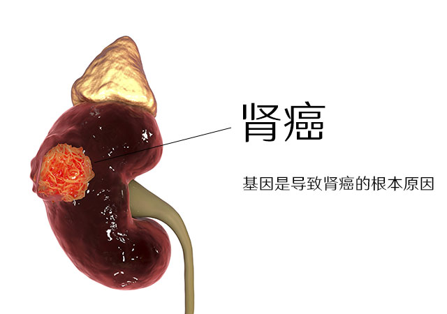 基因是导致肾癌的原因