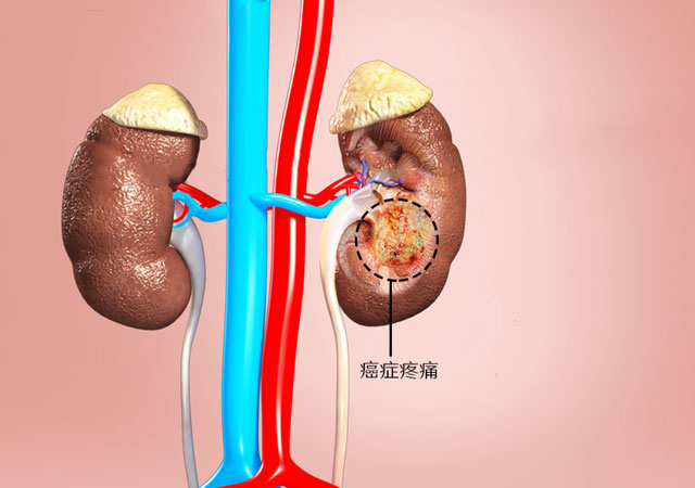 肾癌导致的疼痛治疗方法包括药物和手术