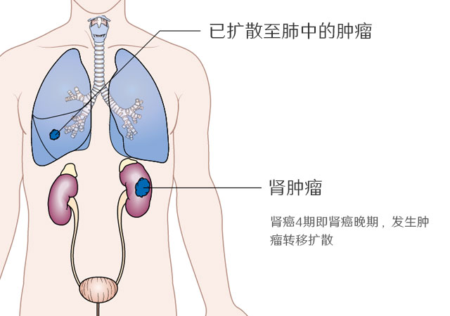 肾癌晚期肿瘤扩散至肺部