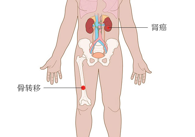 肾癌骨转移