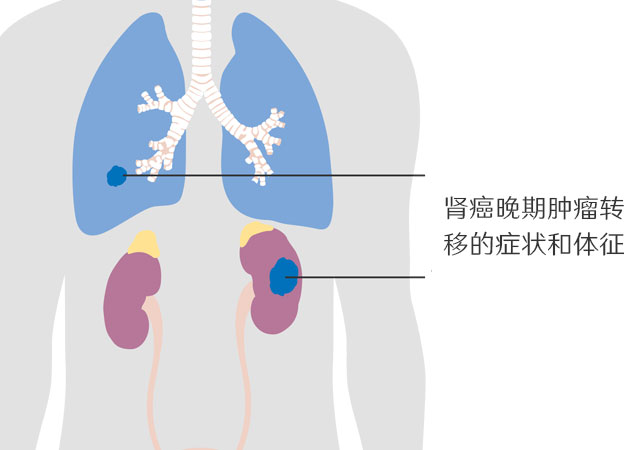 肾癌晚期肿瘤转移到肺部的症状