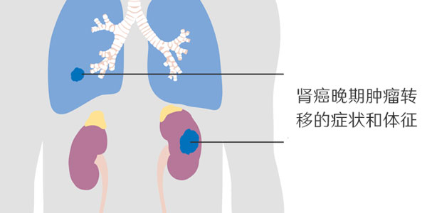 肾癌晚期转移症状和体征表现