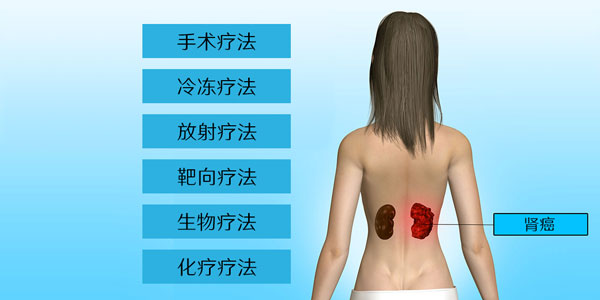 肾癌治疗方法手术冷冻放射靶向生物化疗的副作用