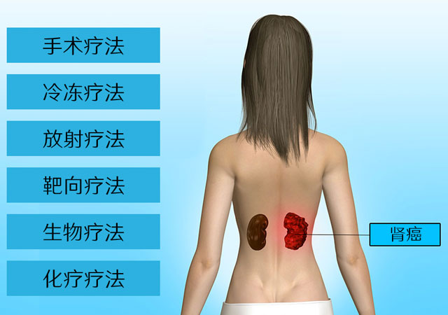 肾癌的治疗方法
