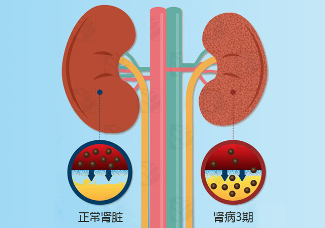 肾病3期有多严重