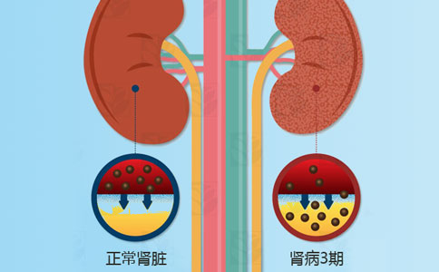 慢性肾病3期严重吗？