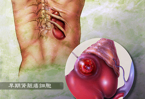 肾癌细胞早期症状图片