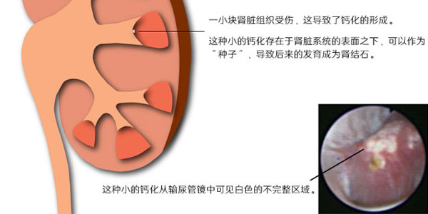 尿液中的肾结晶形成，症状，原因，治疗