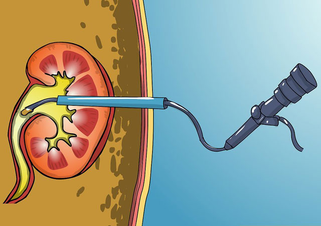 肾结石经皮肾镜取石术