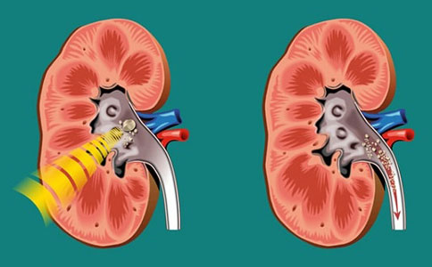 肾结石多大需要碎石，输尿管镜和经皮肾镜取石术治疗？