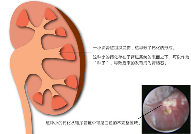 早期的成长阶段也就是肾结晶形成期