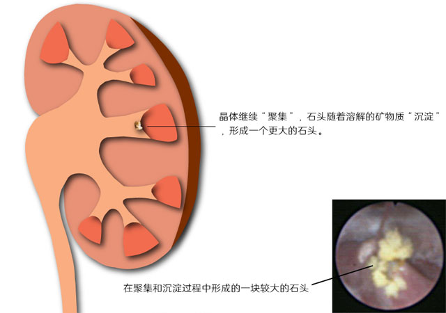 肾结石形成阶段