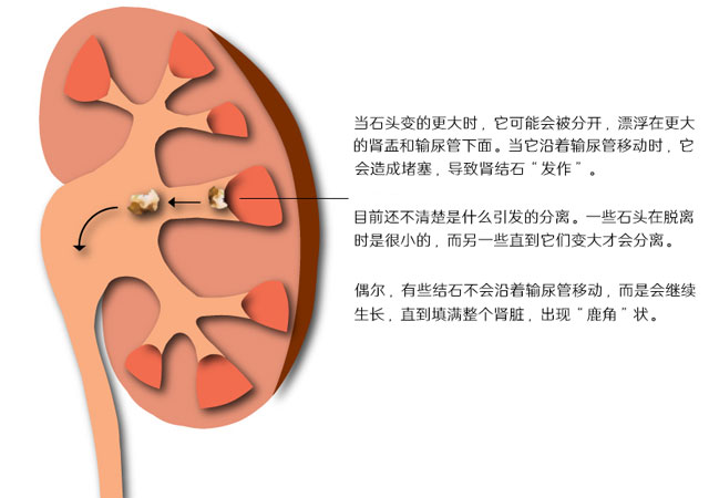 肾结石分离集聚阶段