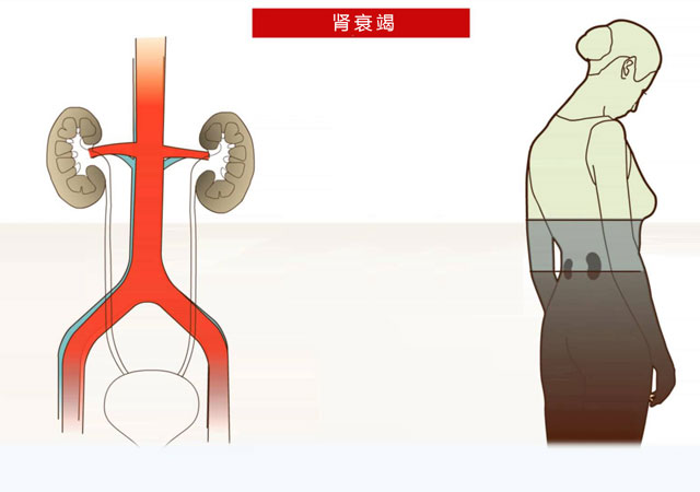 什么原因引起的肾衰竭