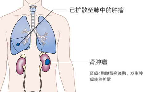 肾癌4期晚期症状怎样治疗还能治愈吗？