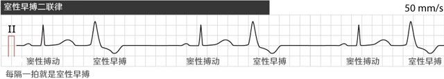 二联律室性早搏心电图