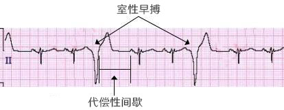 室性早搏心电图检查图