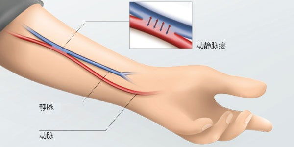 手臂透析做动静脉内瘘真实图片