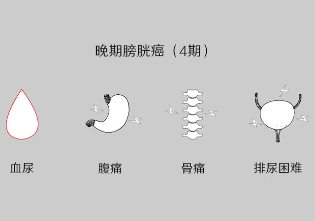 晚期膀胱癌4期有哪些症状及控制治疗？