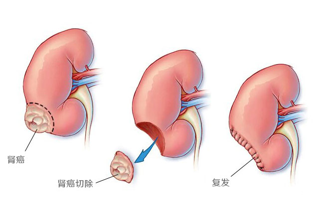 肾癌或癌症容易复发