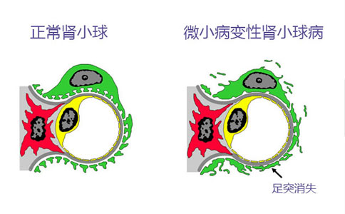 微小病变性肾小球肾炎能治好根治吗？