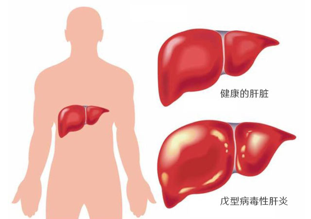 感染戊型病毒性肝炎的肝脏变得肿胀