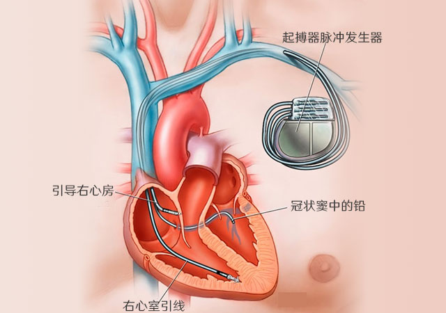 心脏起搏器构成示意图