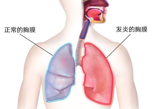 胸膜炎