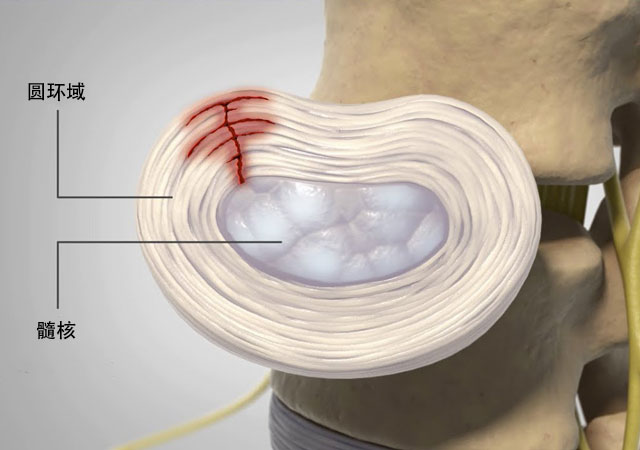 腰间盘突出
