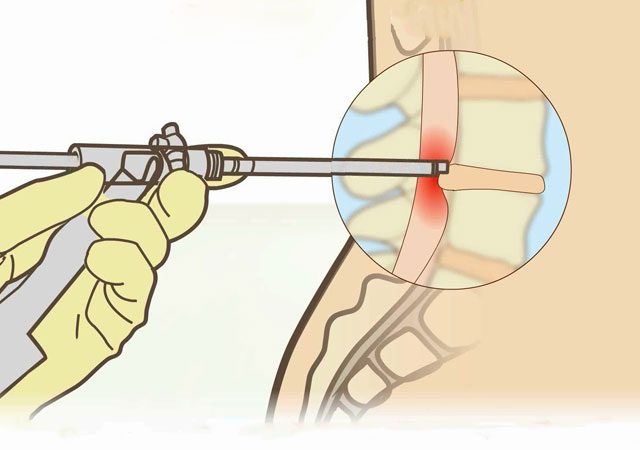 腰椎间盘突出手术治疗方法
