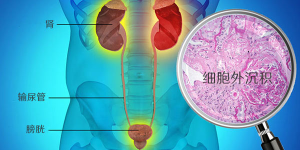 遗传性肾淀粉样变性治疗方法怎么治疗最好