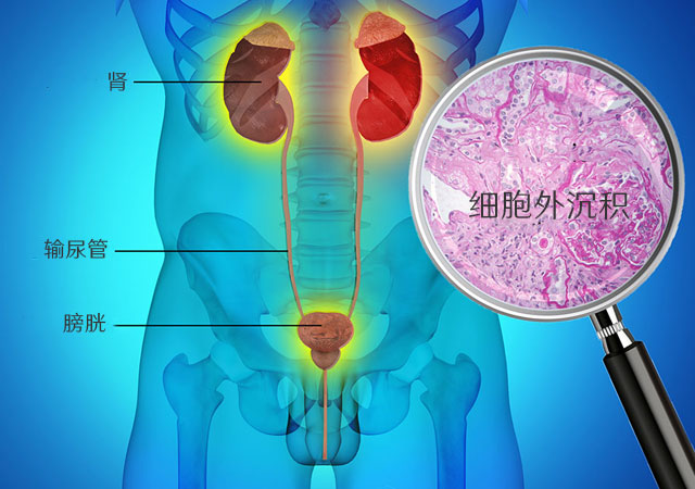 遗传性肾淀粉样变性治疗为肾移植