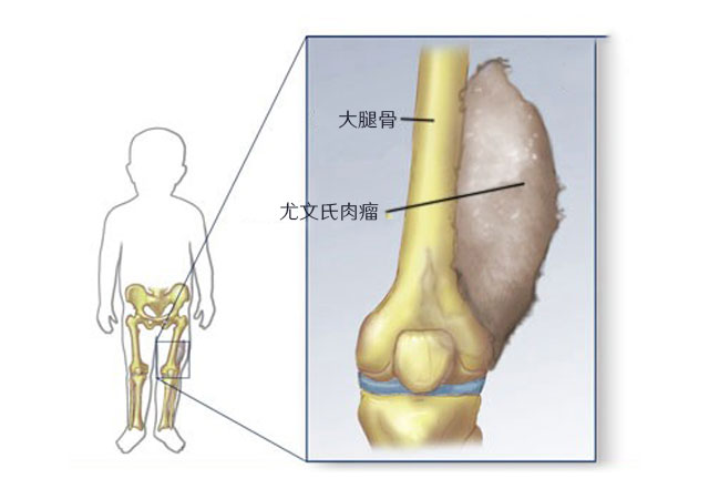 尤因氏肉瘤示意图