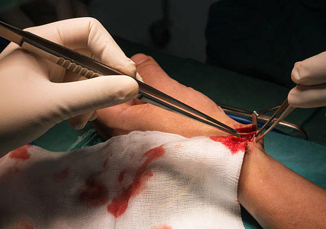 手术团队在手臂做动静脉瘘图片8