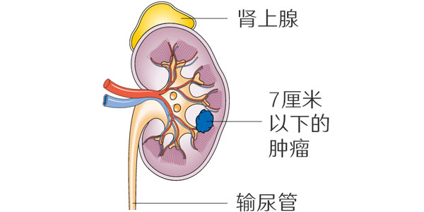 早期肾癌90%可治愈的手术切除治疗方案